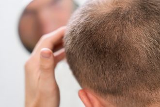 Male androgenetic alopecia: what is it, how to treat it, and how does it affect the man's self-esteem?