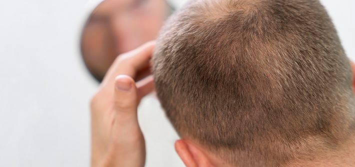 Male androgenetic alopecia: what is it, how to treat it, and how does it affect the man's self-esteem?