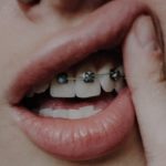 The importance of retainers after braces: a complete overview