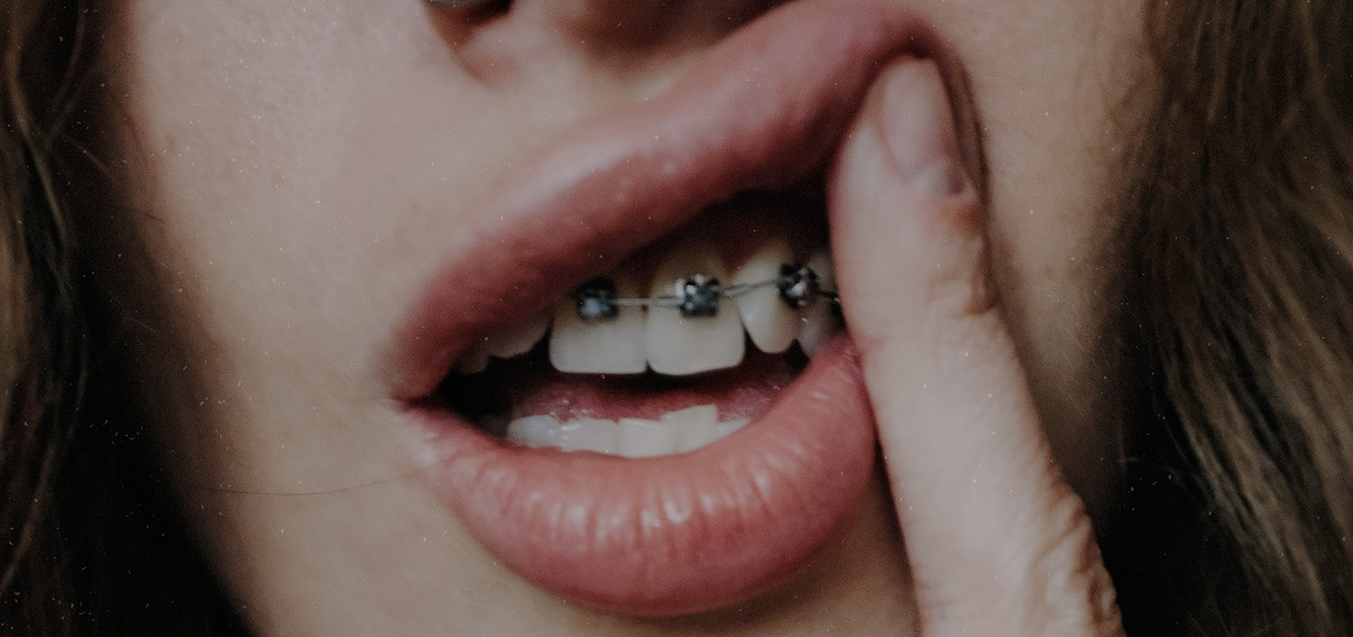 The importance of retainers after braces: a complete overview