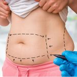 The impact of plastic surgery on self-esteem and body image