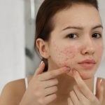 Effective daily skin care tips for control of fungal acne
