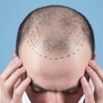The changing cost of hair transplants in the UK