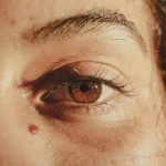 How to identify an itchy mole: signs to look for