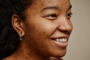 5 Myths About Acne You Need to Stop Believing