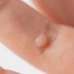 A Deep Dive into the Best Baby Wart Removal Oils
