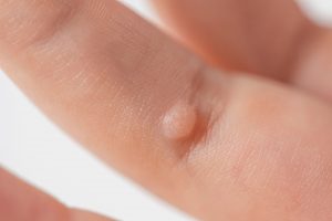 A Deep Dive into the Best Baby Wart Removal Oils
