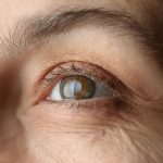 Understanding the Most Common Age for Cataract Surgery in Women