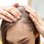 What Is Hair Replacement and Is It Right for You?