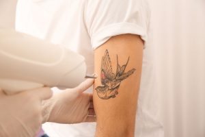 How Tattoo Removal Can Improve Your Mental Health and Confidence