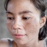 Dermatologist vs. Home Remedies: Navigating Melasma Treatment Options