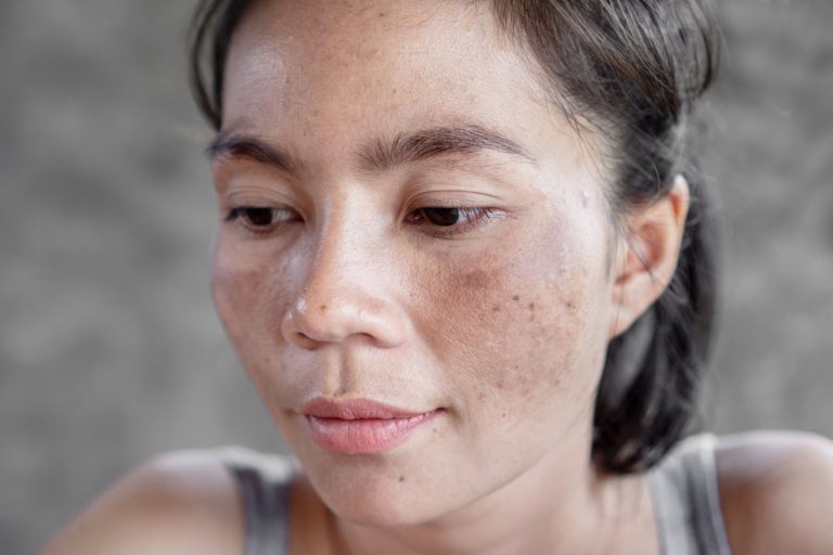 Dermatologist vs. Home Remedies: Navigating Melasma Treatment Options