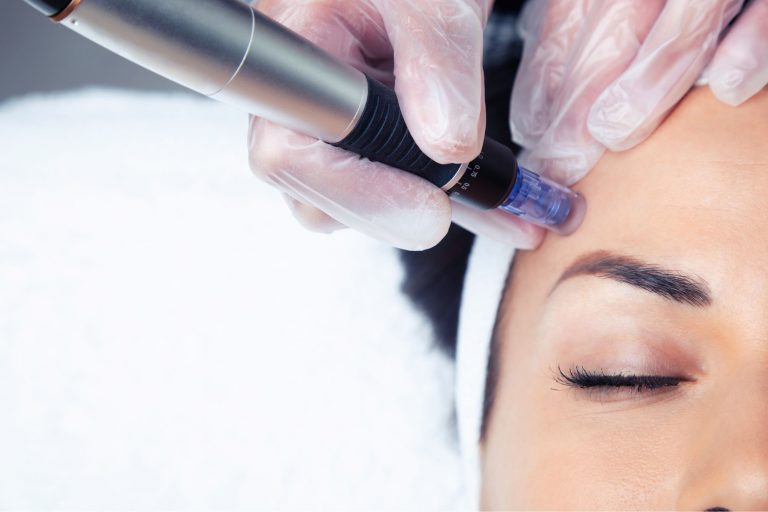 Benefits of Microneedling for Skin Rejuvenation