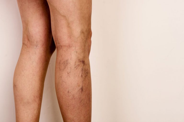 Best Massage Oil For Varicose Veins Best Massage Oil For Varicose Veins