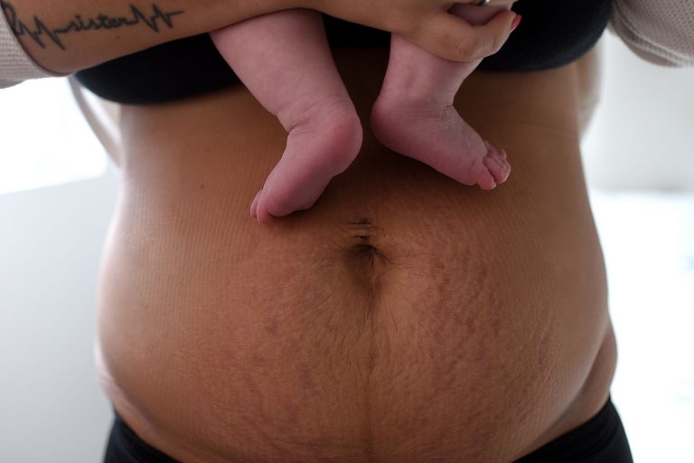 Your Body Is Not Ruined After Postpartum Surgery, and Healing Can Still Feel Beautiful 