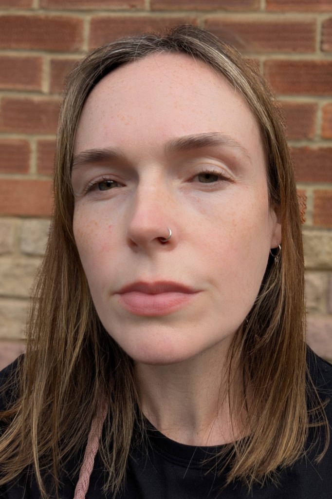 Before treatment, no makeup, outside